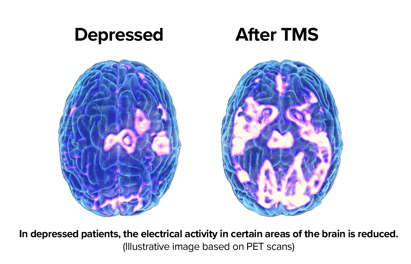 The Use Of Tms In Depression Transforming Mind Solutions